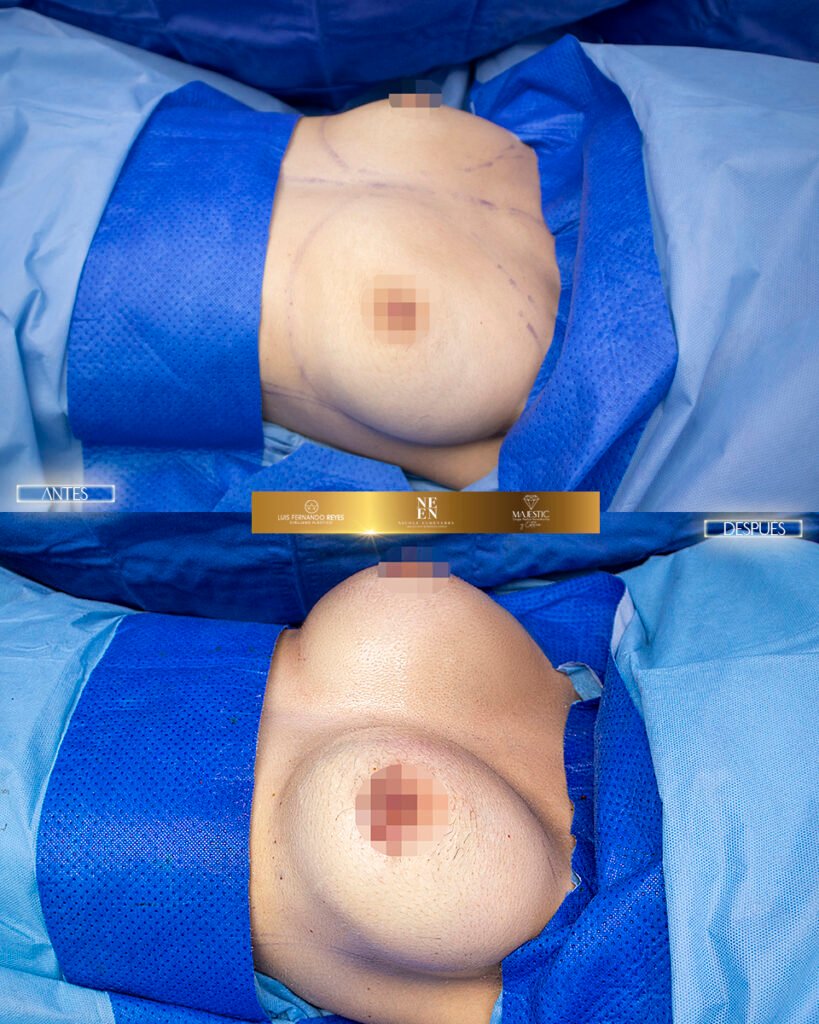 Mamoplastia de Aumento